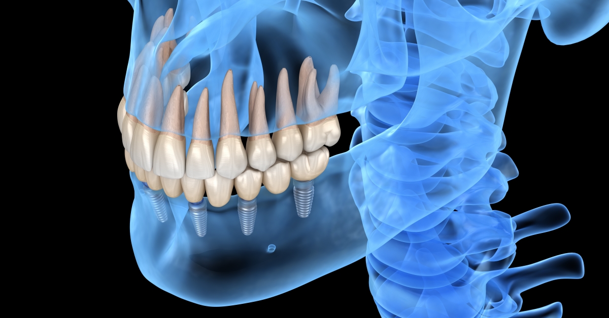 Modern dental implant procedures 3D imaging